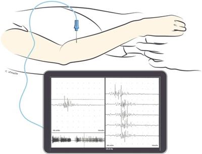 Assessment, patient selection, and rehabilitation of nerve transfers
